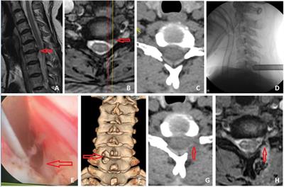 Frontiers Posterior Cervical Full Endoscopic Technique For The